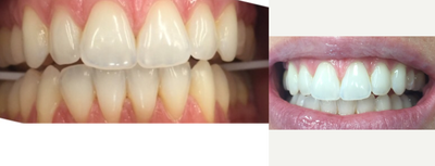 Teeth Whitening before and after photo