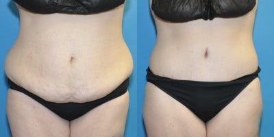 Tummy Tuck before and after photo