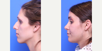 Brow Lift before and after photo