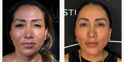 Brow Lift before and after photo