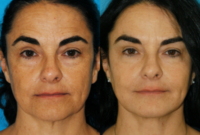 Clear and Brilliant before and after photo