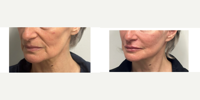 Deep Plane Facelift before and after photo