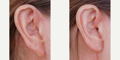 Ear Surgery before and after photo