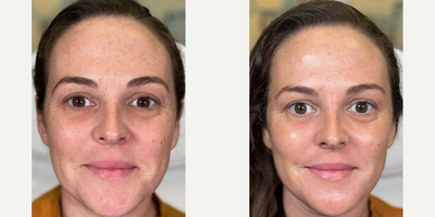 HydraFacial before and after photo