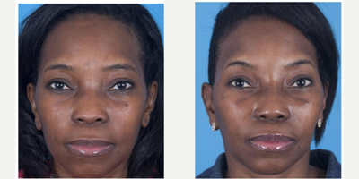African American Rhinoplasty before and after photo