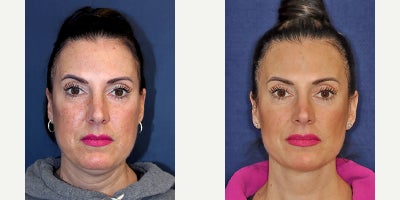 Deep Plane Facelift before and after photo