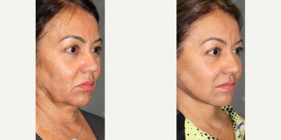 Facelift before and after photo