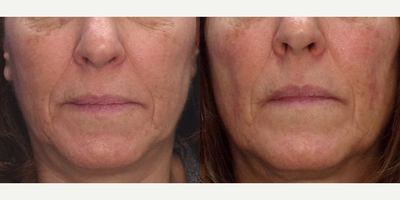 Skin Rejuvenation before and after photo