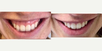 Botox for Gummy Smile before and after photo