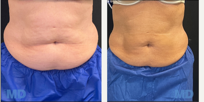 CoolSculpting before and after photo