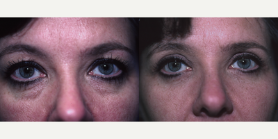 Eyelid Surgery before and after photo