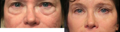 Eyelid Surgery before and after photo