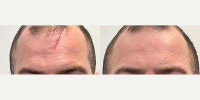 Fraxel Laser before and after photo