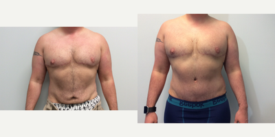 Liposuction before and after photo