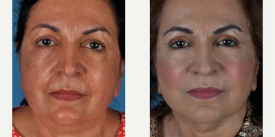Neck Lift before and after photo