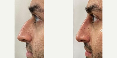 Nonsurgical Nose Job before and after photo