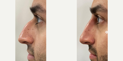 Nonsurgical Nose Job before and after photo