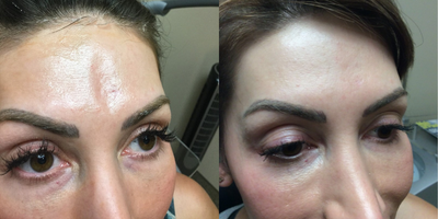 PRP Injections before and after photo