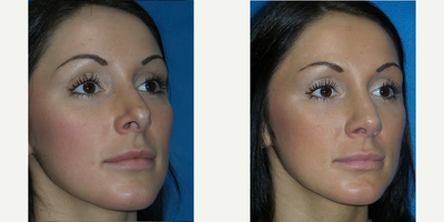 Rhinoplasty before and after photo