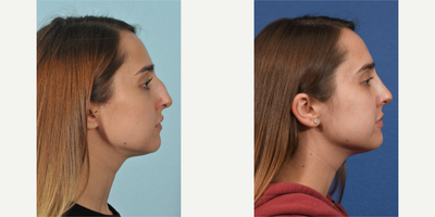 Rhinoplasty before and after photo