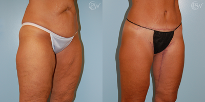 Thigh Lift before and after photo