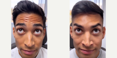 Botox before and after photo
