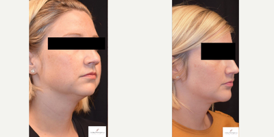 Chin Implant before and after photo
