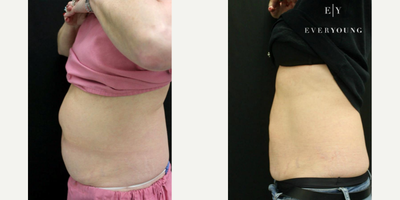 CoolSculpting before and after photo