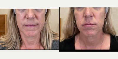 Dermal Fillers before and after photo