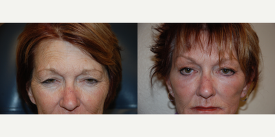 Facelift before and after photo