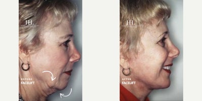 Facelift before and after photo