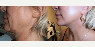 Mini Facelift before and after photo