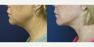 Neck Lift before and after photo
