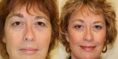 Brow Lift before and after photo