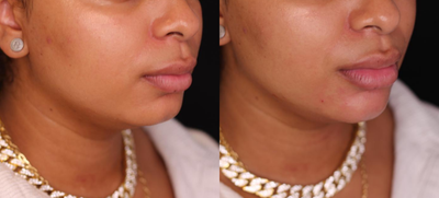 Chin Filler before and after photo