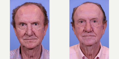 CO2 Laser before and after photo