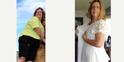 Gastric Bypass before and after photo
