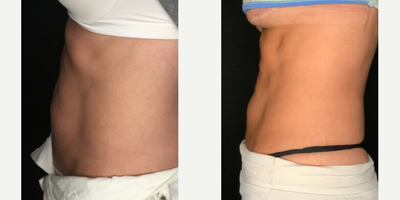 Skin Rejuvenation before and after photo