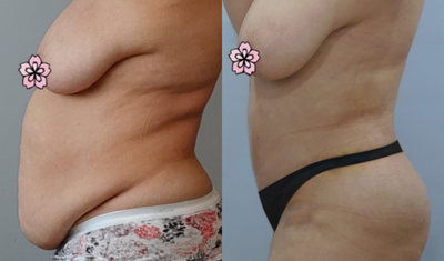 Tummy Tuck before and after photo