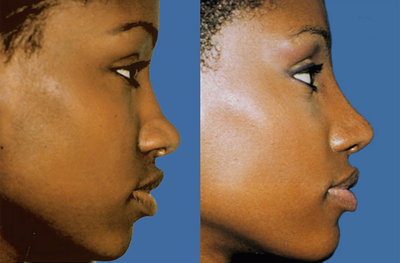 African American Rhinoplasty before and after photo