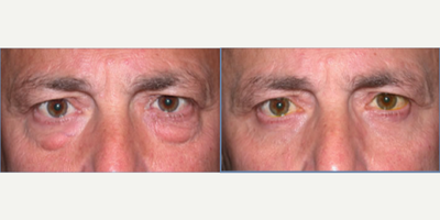 Eyelid Surgery before and after photo