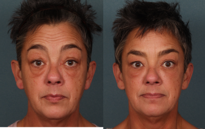 Eyelid Surgery before and after photo