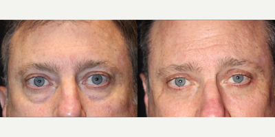 Eyelid Surgery before and after photo