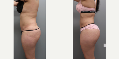 Lipo 360 BBL before and after photo