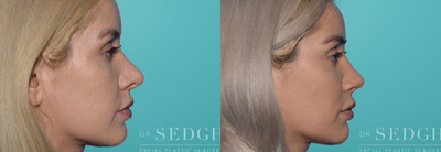 Revision Rhinoplasty before and after photo