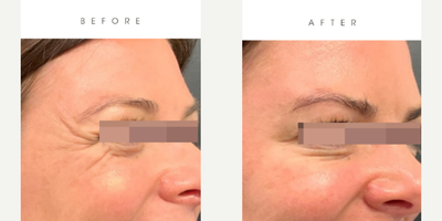 Botox before and after photo