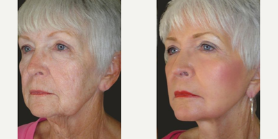Laser Resurfacing before and after photo