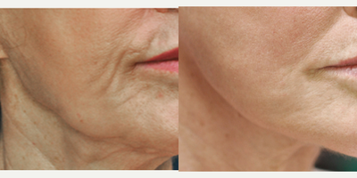 Nonsurgical Facelift before and after photo