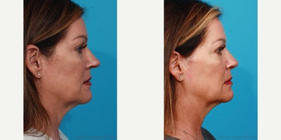 Rhinoplasty before and after photo
