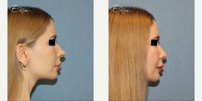 Rhinoplasty before and after photo